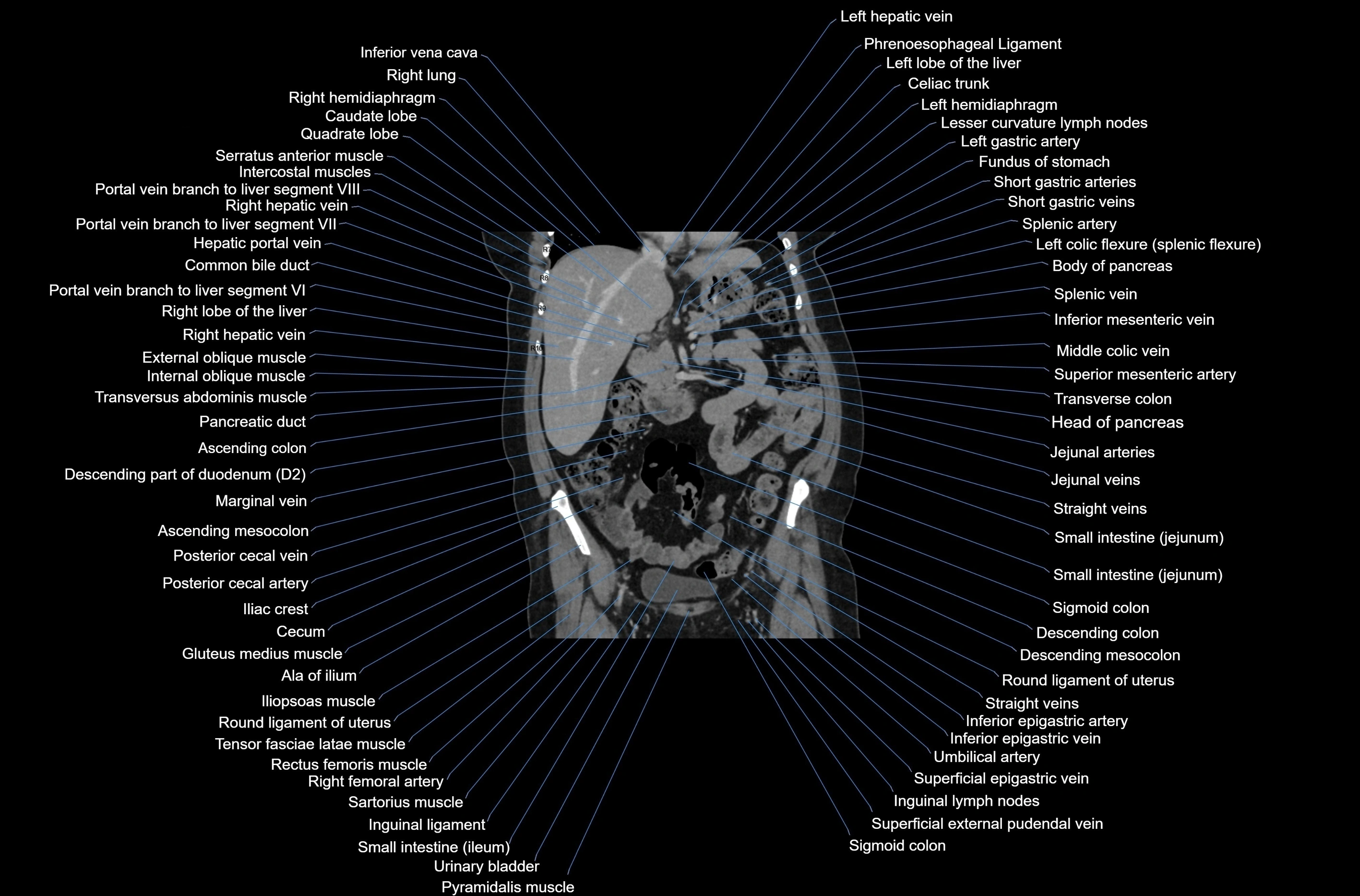CT abdomen coronal cross sectional anatomy labelled radiology image-00038.webp
